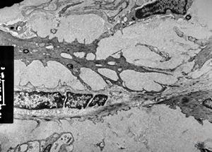 M,60y. | jejunum - amyloidosis